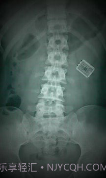 X射线扫描器胃截图3 X射线扫描器胃截图3